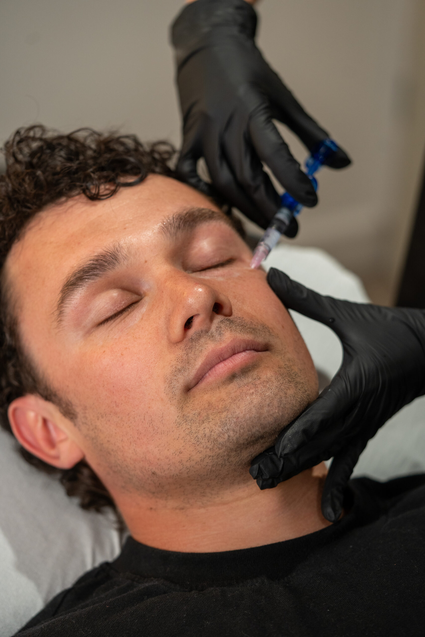 Skin tightening treatment at SculptSkin