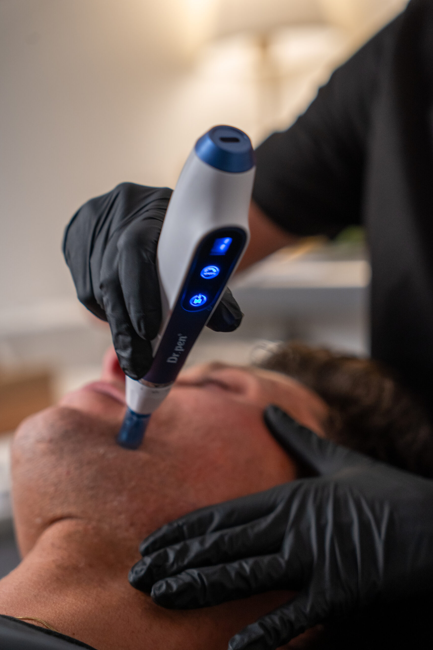 Skin tightening treatment at SculptSkin